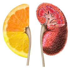 9 Natural Home Remedy for Kidney Stone